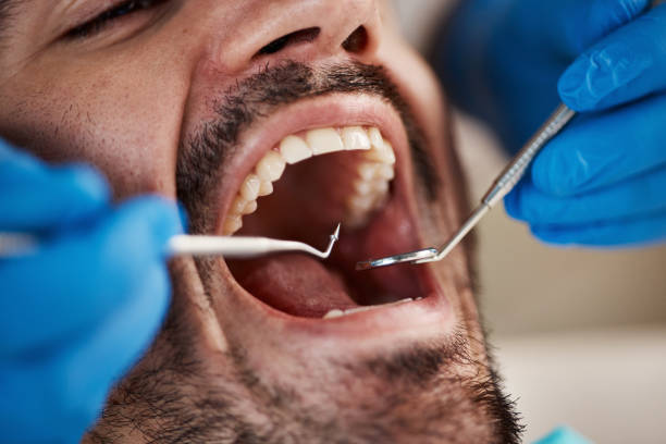 Best Knocked-Out Tooth (Avulsed Tooth) Treatment in Balch Springs, TX